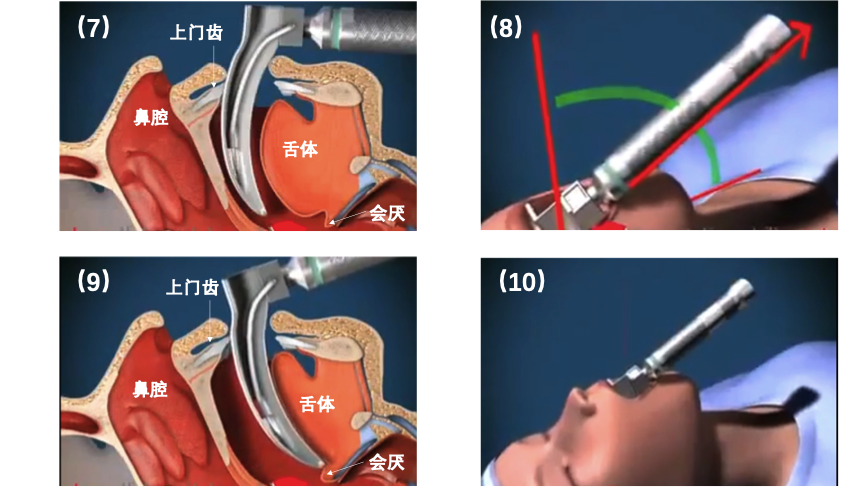 可视喉镜气管插管步骤图片