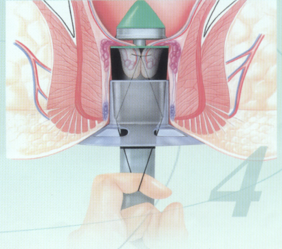 吻合器痔上粘膜环切术