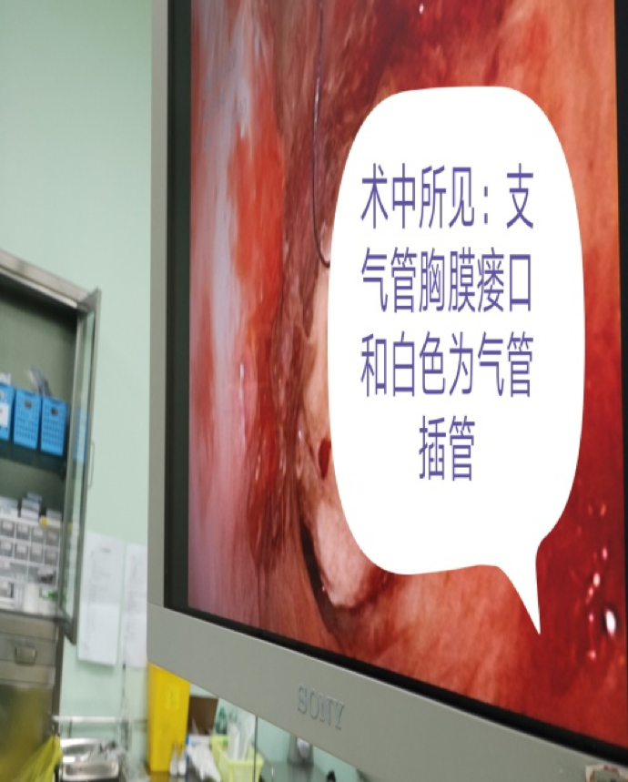 4，术中，为患者修补支气管胸膜瘘口.png